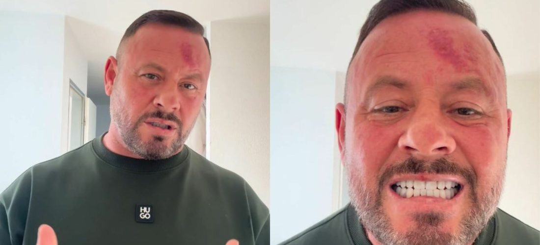 “I njoh të dy” – Rasimi shfaqet i mavijosur pas rrahjes, i quan ‘besprema’ dhe mohon se i janë thyer dhëmbët