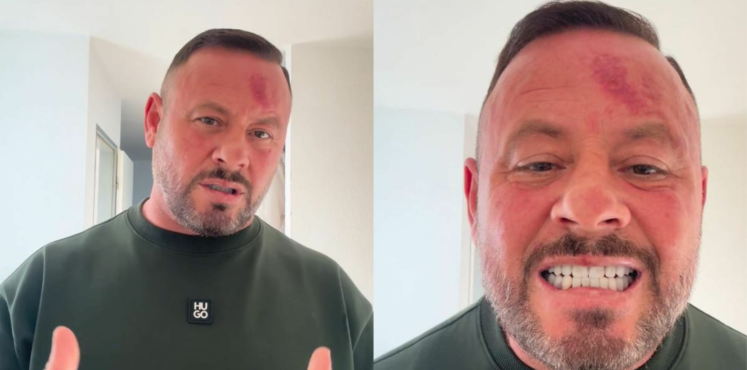  I njoh të dy    Rasimi shfaqet i mavijosur pas rrahjes  i quan  besprema  dhe mohon se i janë thyer dhëmbët